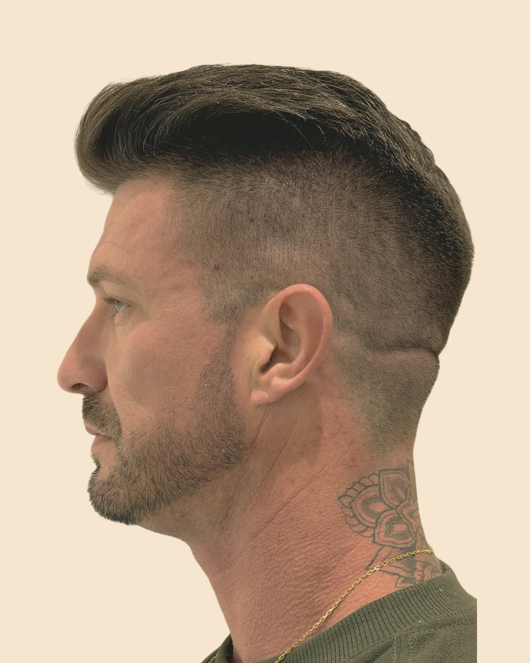 Antes: rosto de perfil de um homem de barba, com o contorno da mandíbula e do queixo menos marcado, sobre fundo claro