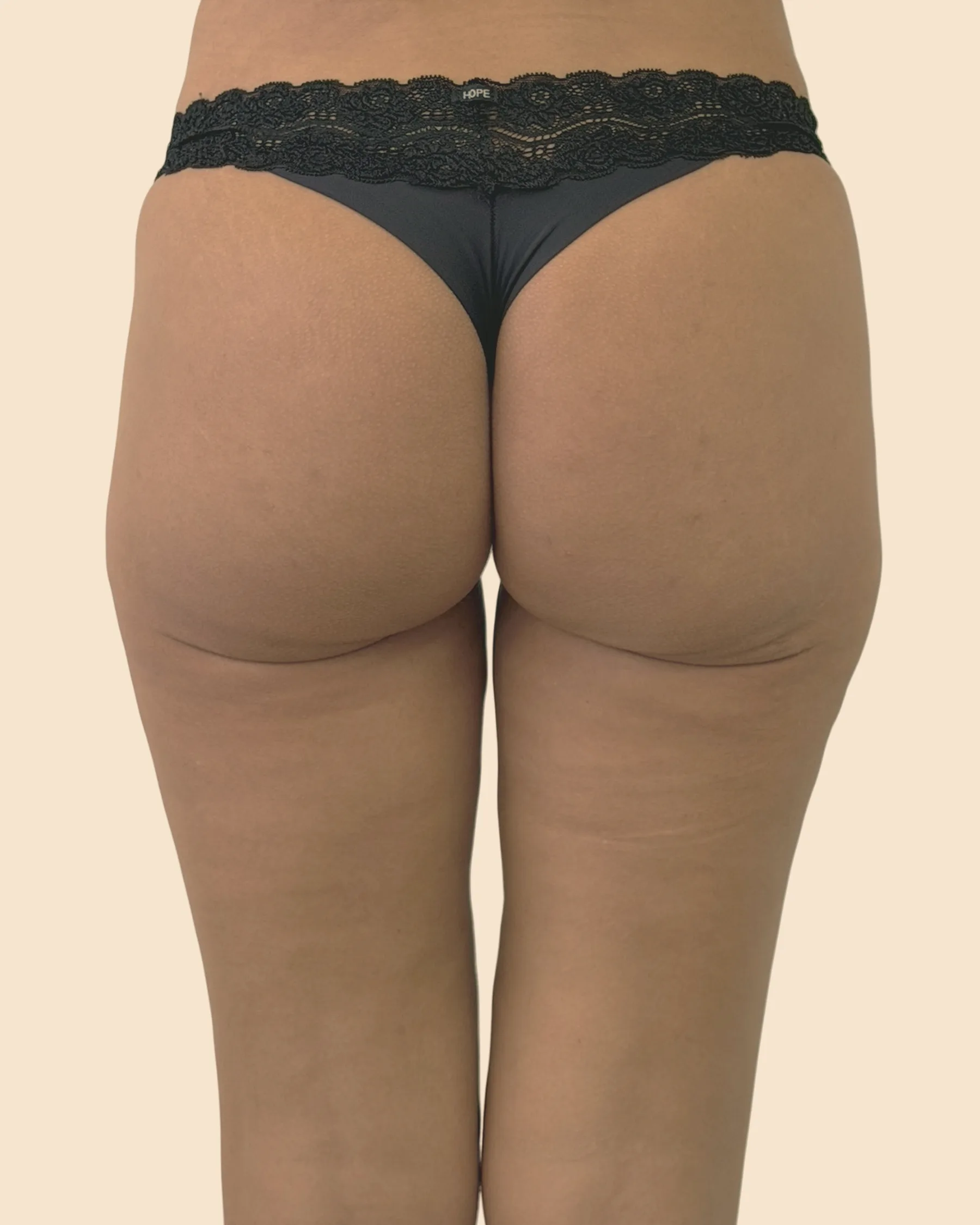 Antes: glúteos vistos de costas, de roupa íntima escura, com pouco volume e o contorno achatado, sobre fundo claro