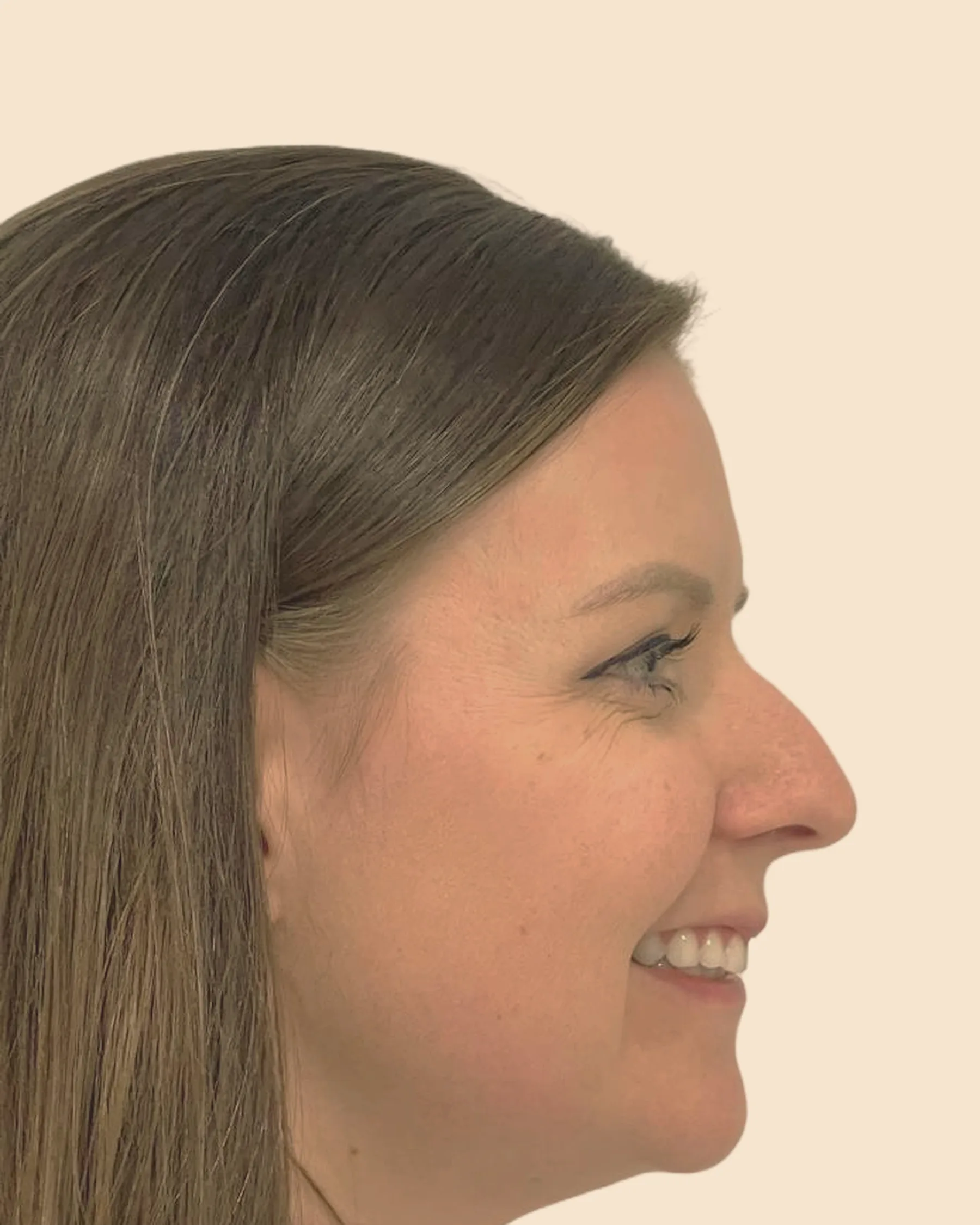 Antes: perfil de uma mulher sorrindo, com uma pequena curva no dorso do nariz e a ponta inclinada para baixo, sobre fundo claro