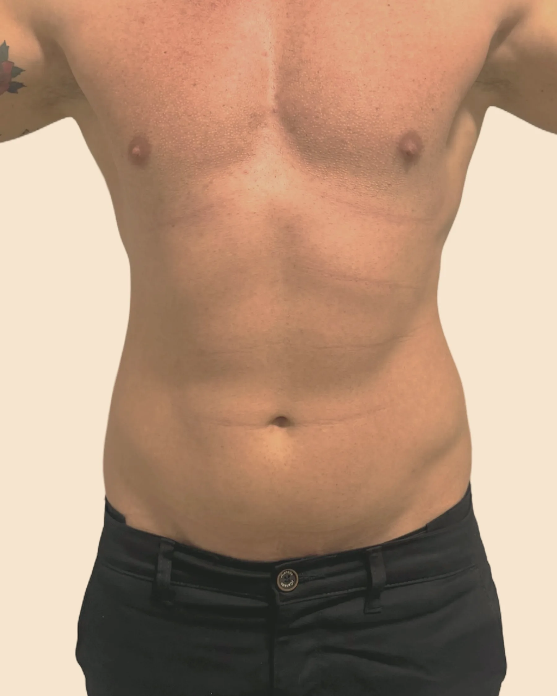 Antes: abdômen de frente de um homem, com gordura localizada na barriga e nos flancos, sobre fundo claro