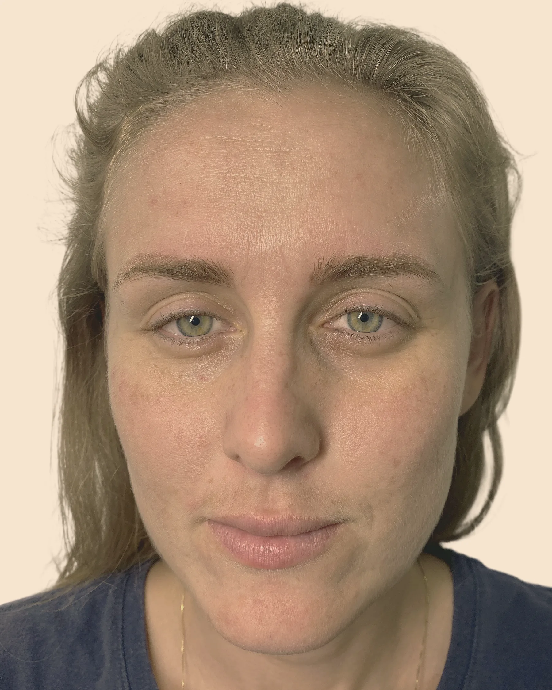 Antes: rosto de frente de uma mulher de cabelo loiro preso, com a pele de aspecto cansado e irregular, sobre fundo claro