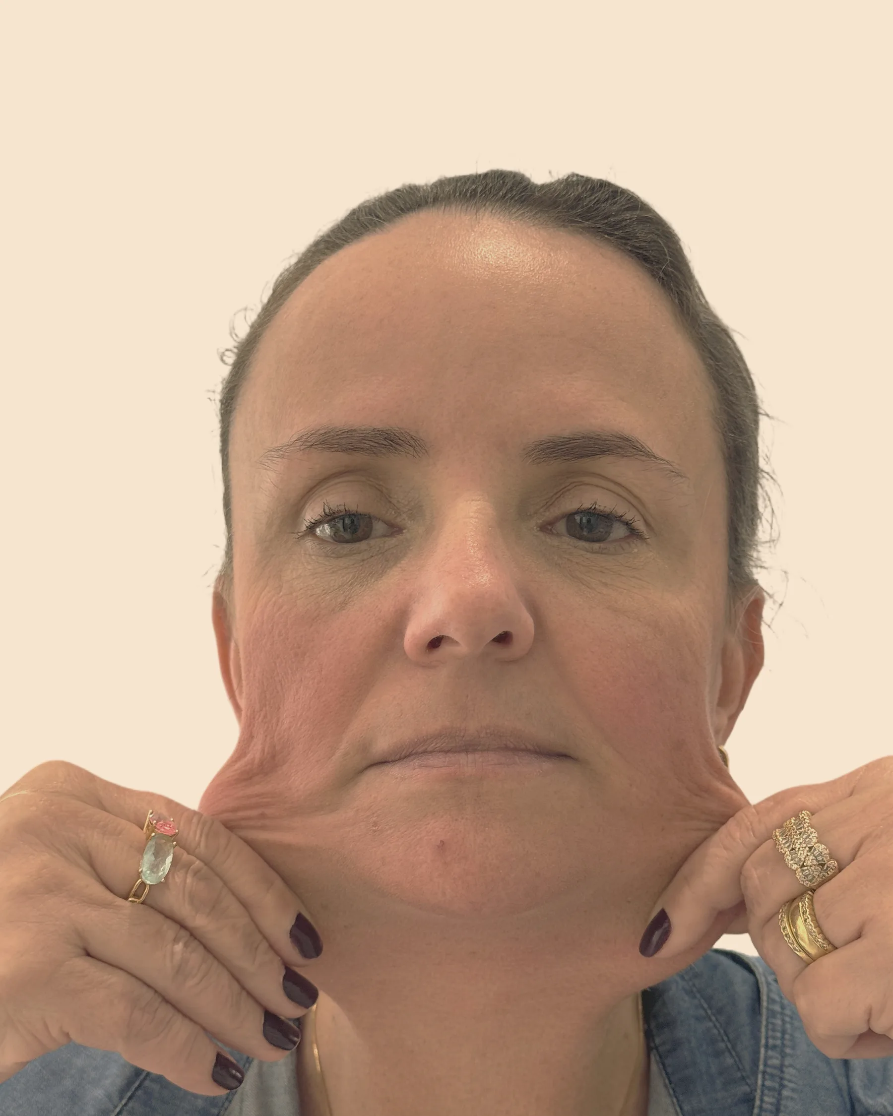 Antes: rosto de frente de uma mulher puxando com as mãos a pele das bochechas, que mostra a flacidez, sobre fundo claro