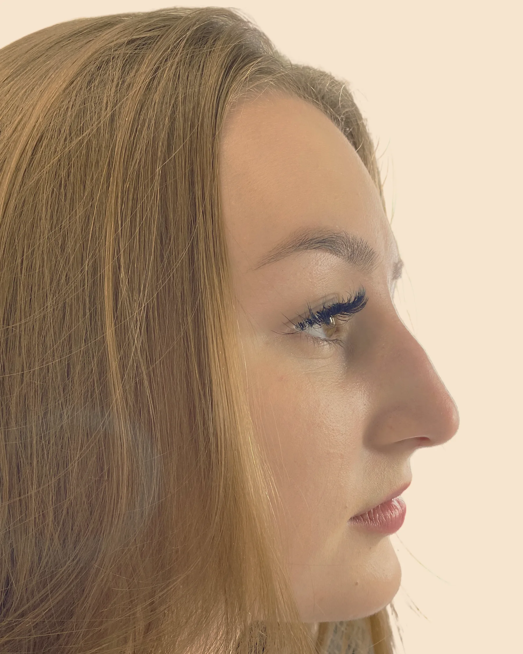 Antes: perfil de uma mulher de lábios fechados, com uma pequena saliência no dorso do nariz e a ponta inclinada para baixo, sobre fundo claro
