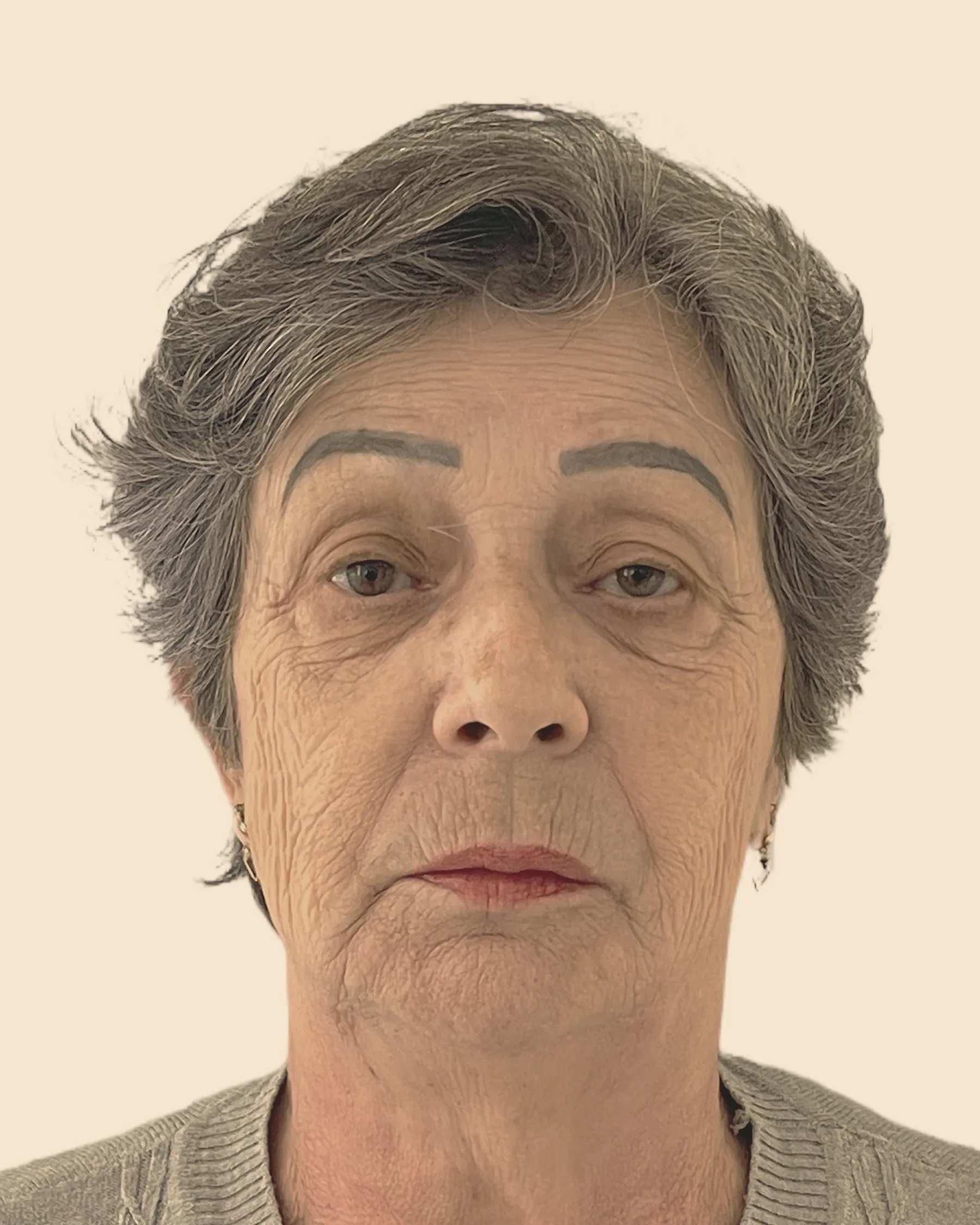 Antes: rosto de frente de uma mulher de cabelo grisalho e curto, com rugas, bolsas sob os olhos e o contorno do rosto mais caído, sobre fundo claro