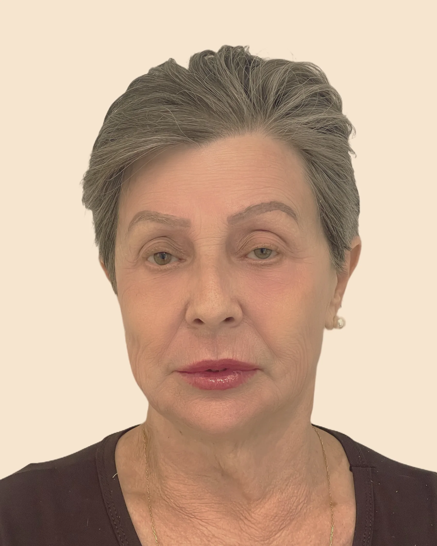 Depois: o mesmo rosto de frente, com a pele mais lisa e o contorno do rosto mais firme, sobre fundo claro