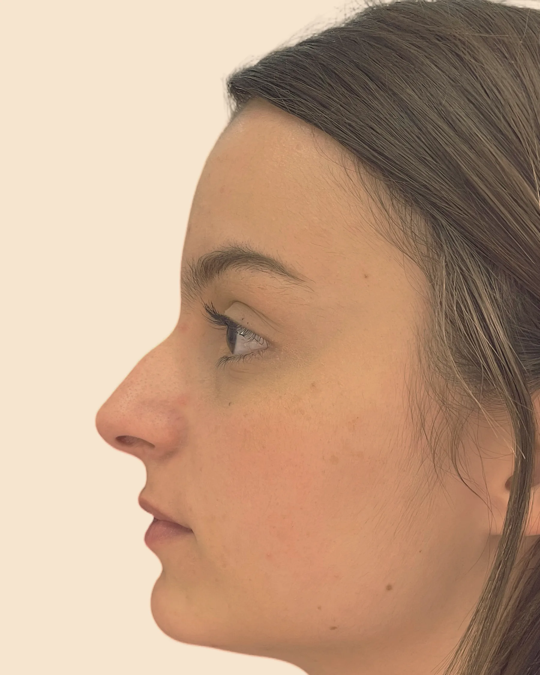 Antes: perfil de uma mulher de cabelo castanho, virada para a esquerda, com uma leve curva no dorso do nariz e a ponta inclinada para baixo, sobre fundo claro