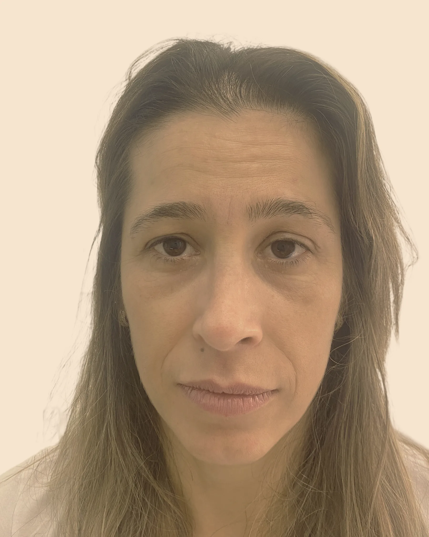 Antes: rosto de frente de uma mulher de cabelo castanho e liso, com o rosto mais fundo e olheiras marcadas, sobre fundo claro