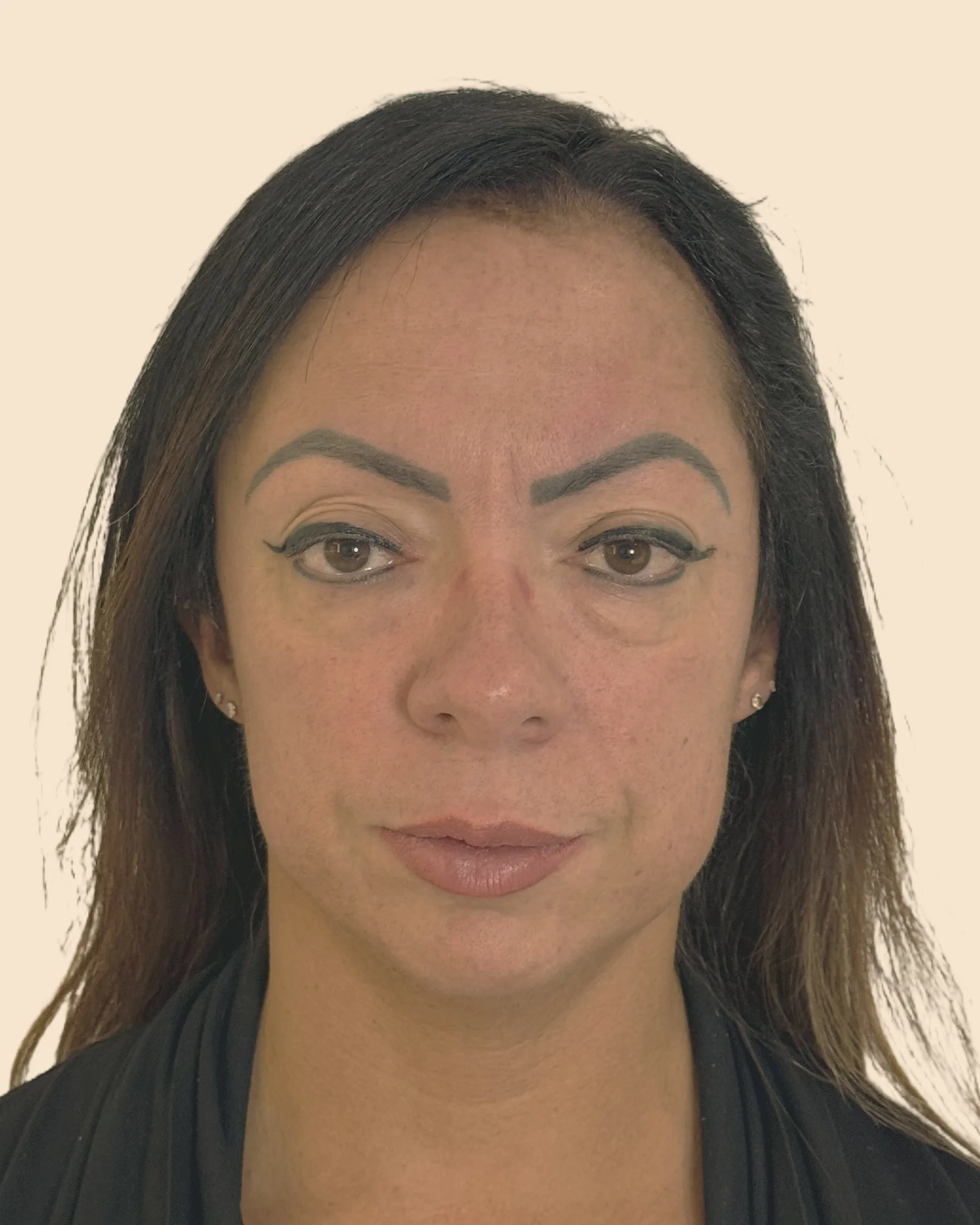 Antes: rosto de frente de uma mulher de cabelo escuro e liso, com a pele manchada e o contorno do rosto menos definido, sobre fundo claro