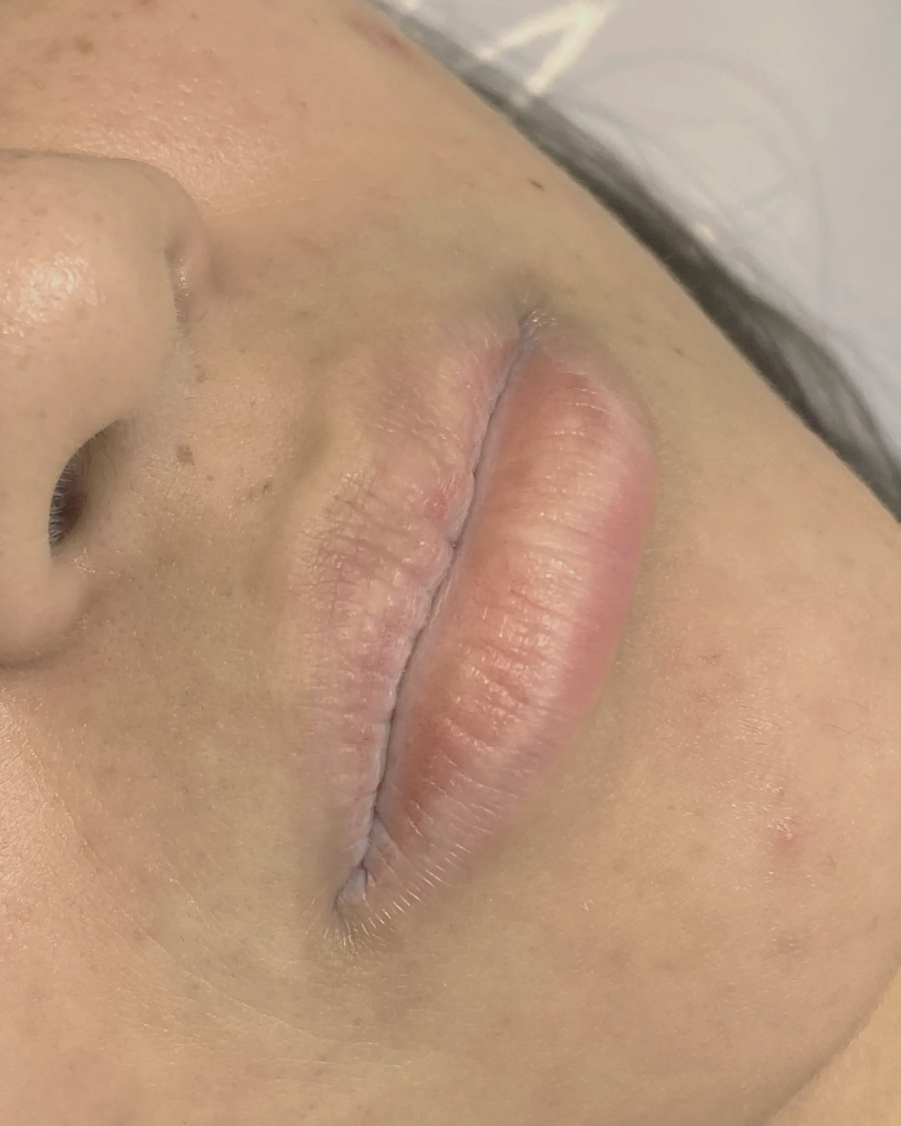 Antes: lábios vistos de perto e de lado, com pouco volume e o contorno apagado