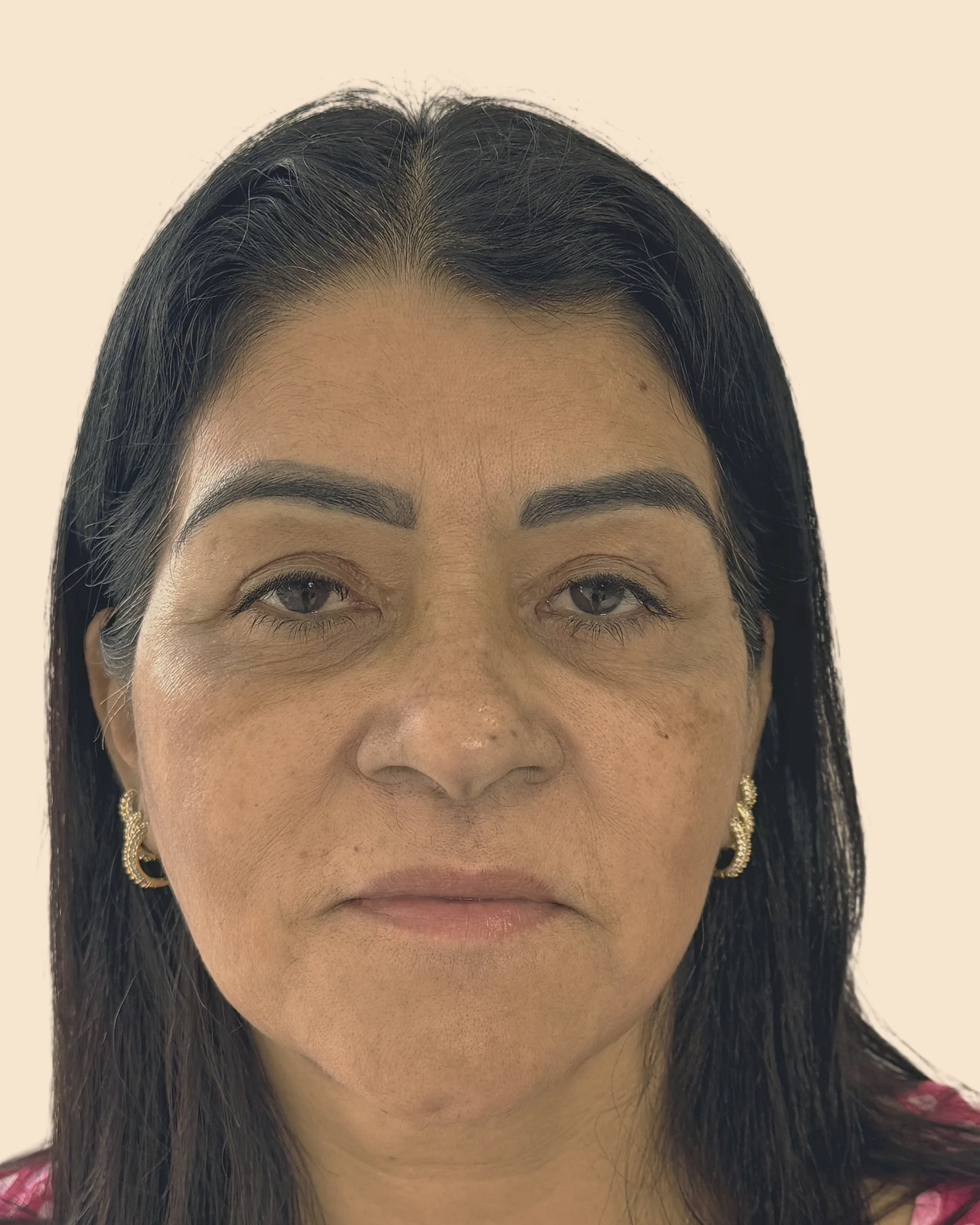 Antes: rosto de frente de uma mulher de cabelo escuro, com bolsas sob os olhos, sulcos marcados e o contorno do rosto mais caído, sobre fundo claro