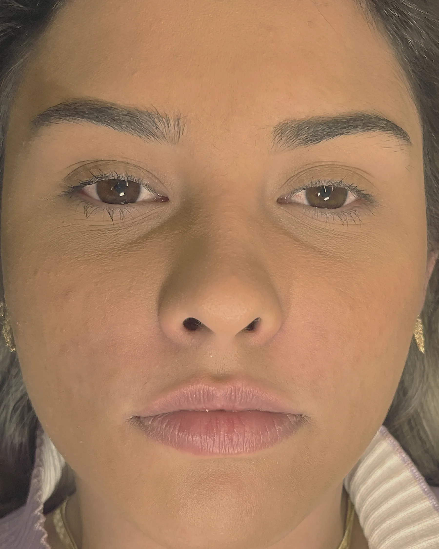 Antes: rosto de frente de uma mulher de cabelo escuro, com os lábios finos