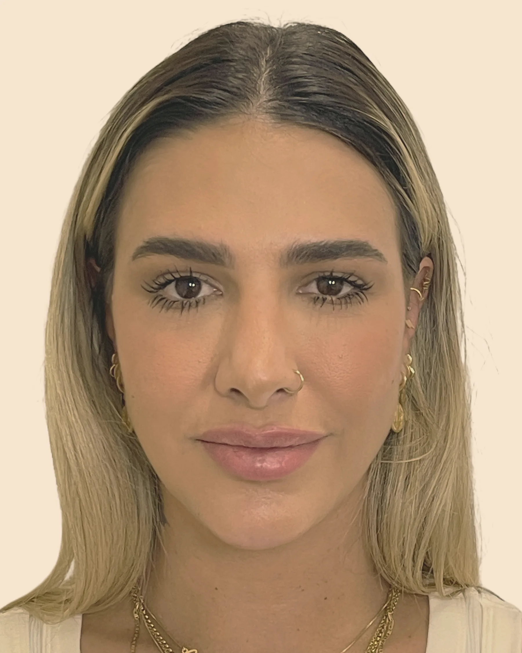 Antes: rosto de frente de uma mulher de cabelo loiro, com o contorno da mandíbula mais arredondado, sobre fundo claro