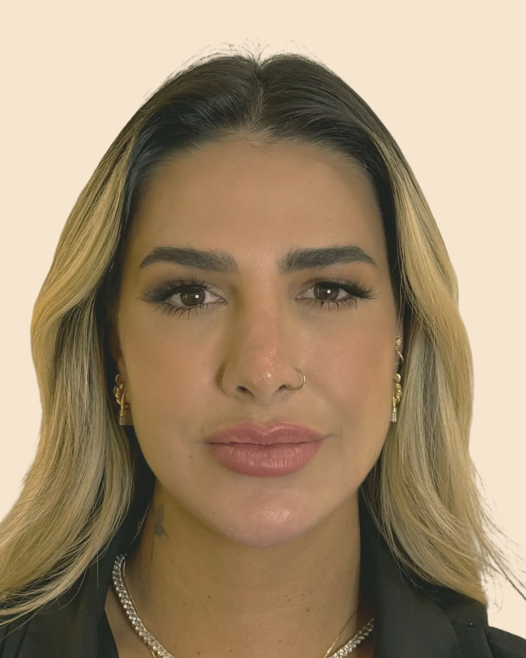 Depois: o mesmo rosto de frente, com o contorno da mandíbula e do queixo mais definido, sobre fundo claro